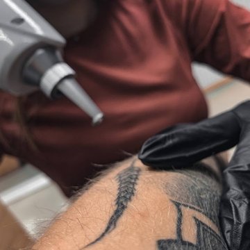 Discounts on Repeat Tattoo Removal